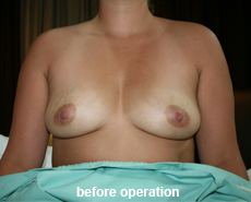 plastic-surgery-breast-augmentation